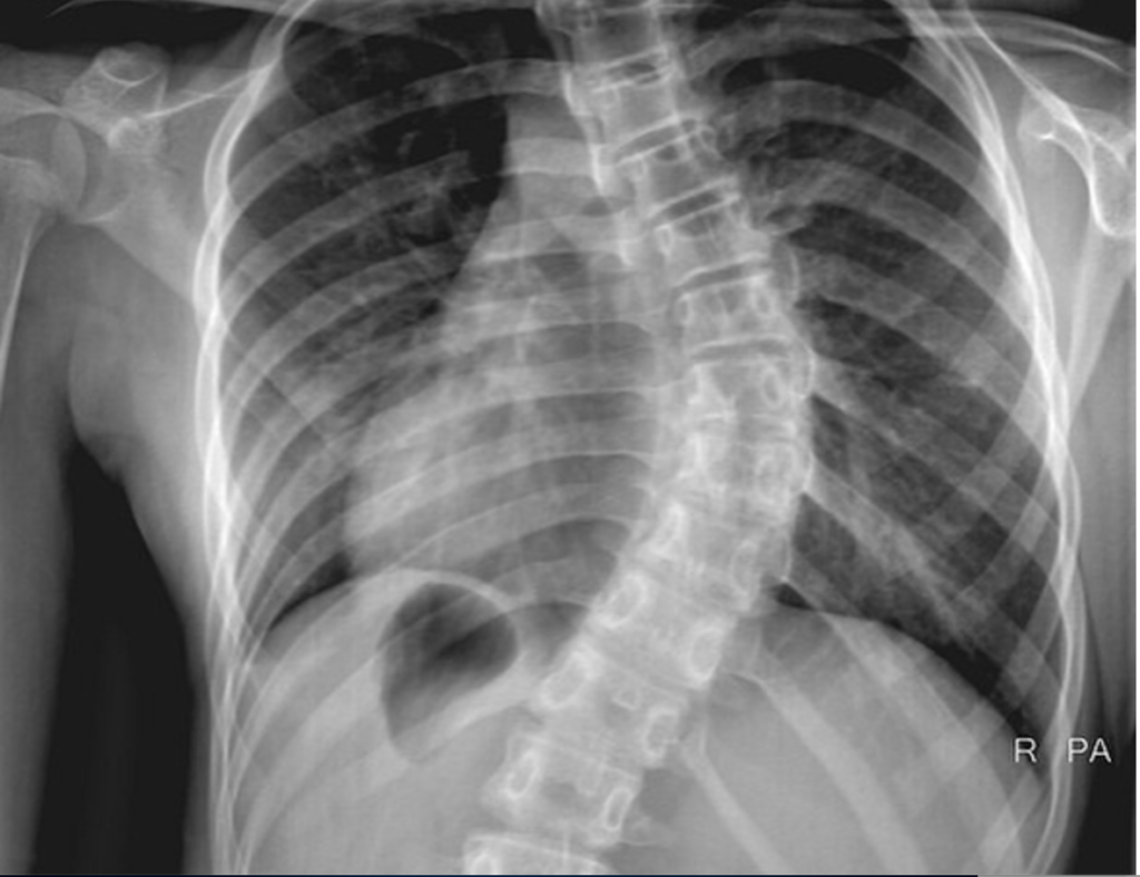 What Do Scoliosis, Sleep Wrinkles, and Two Canadian Nurses Have in Common?