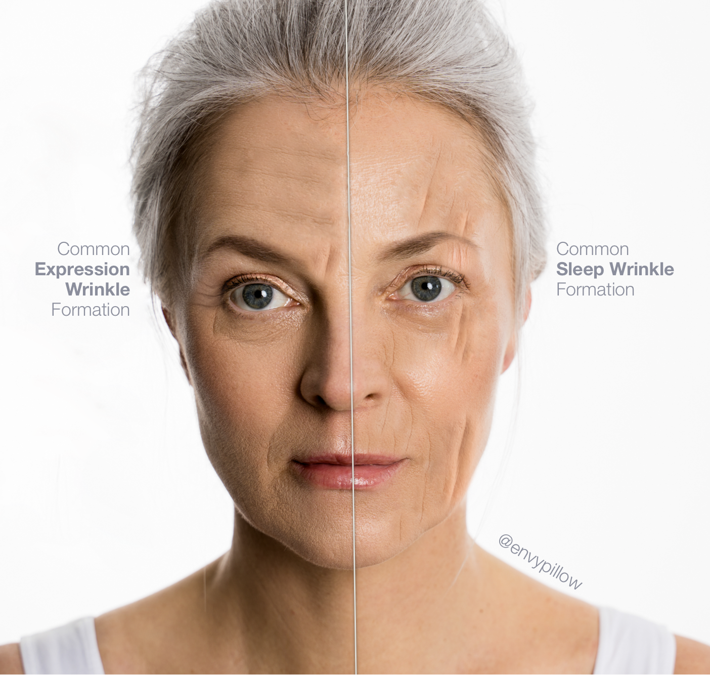Side by side comparison of sleep wrinkles and expression wrinkles